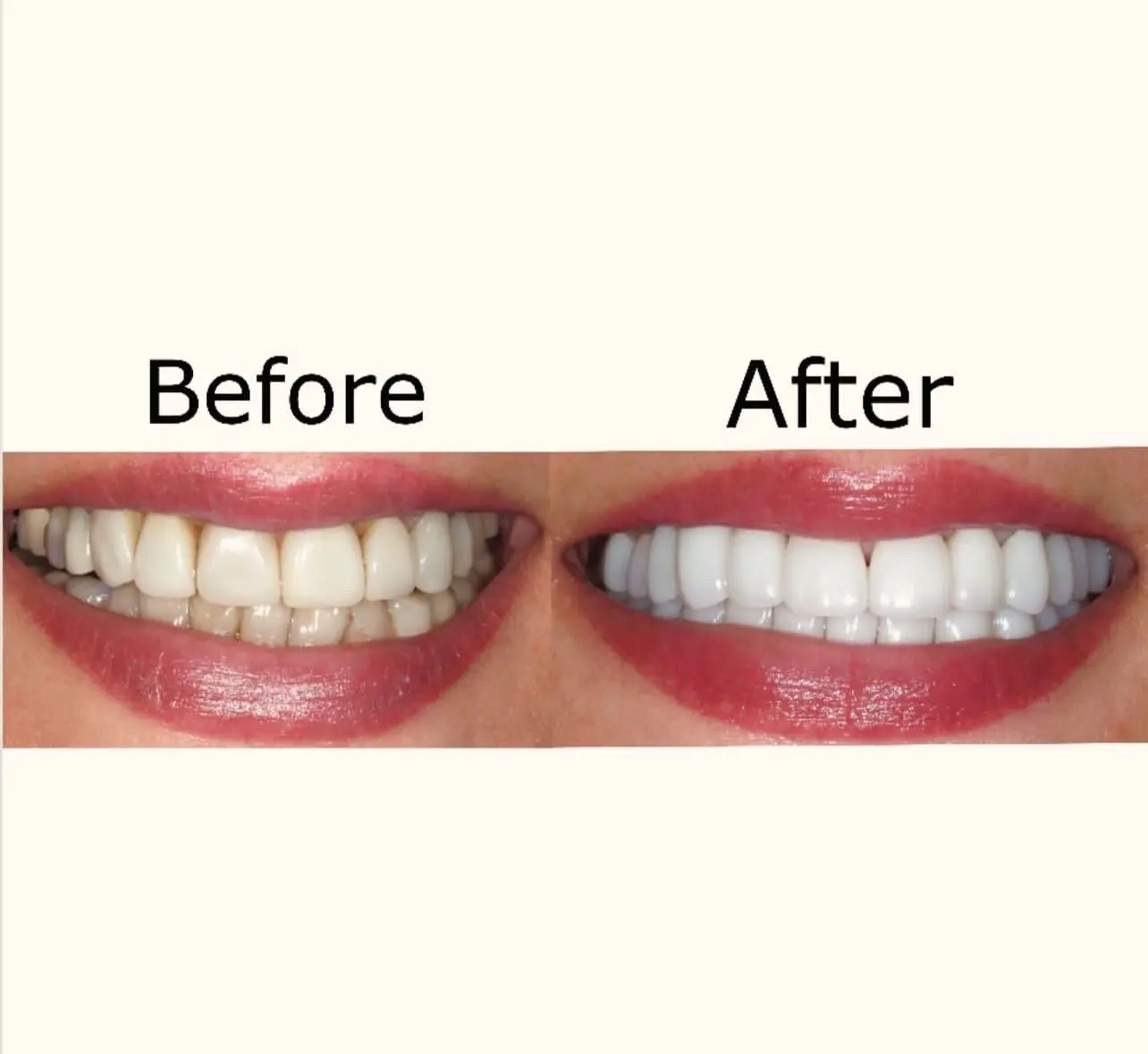 A before and after picture of teeth whitening